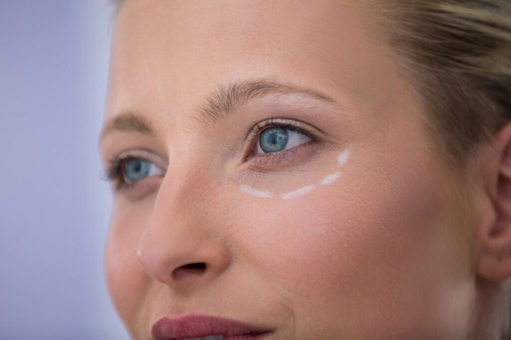 Baby Botox, Augenpartie einer Patientin wurde markiert für Eingriff