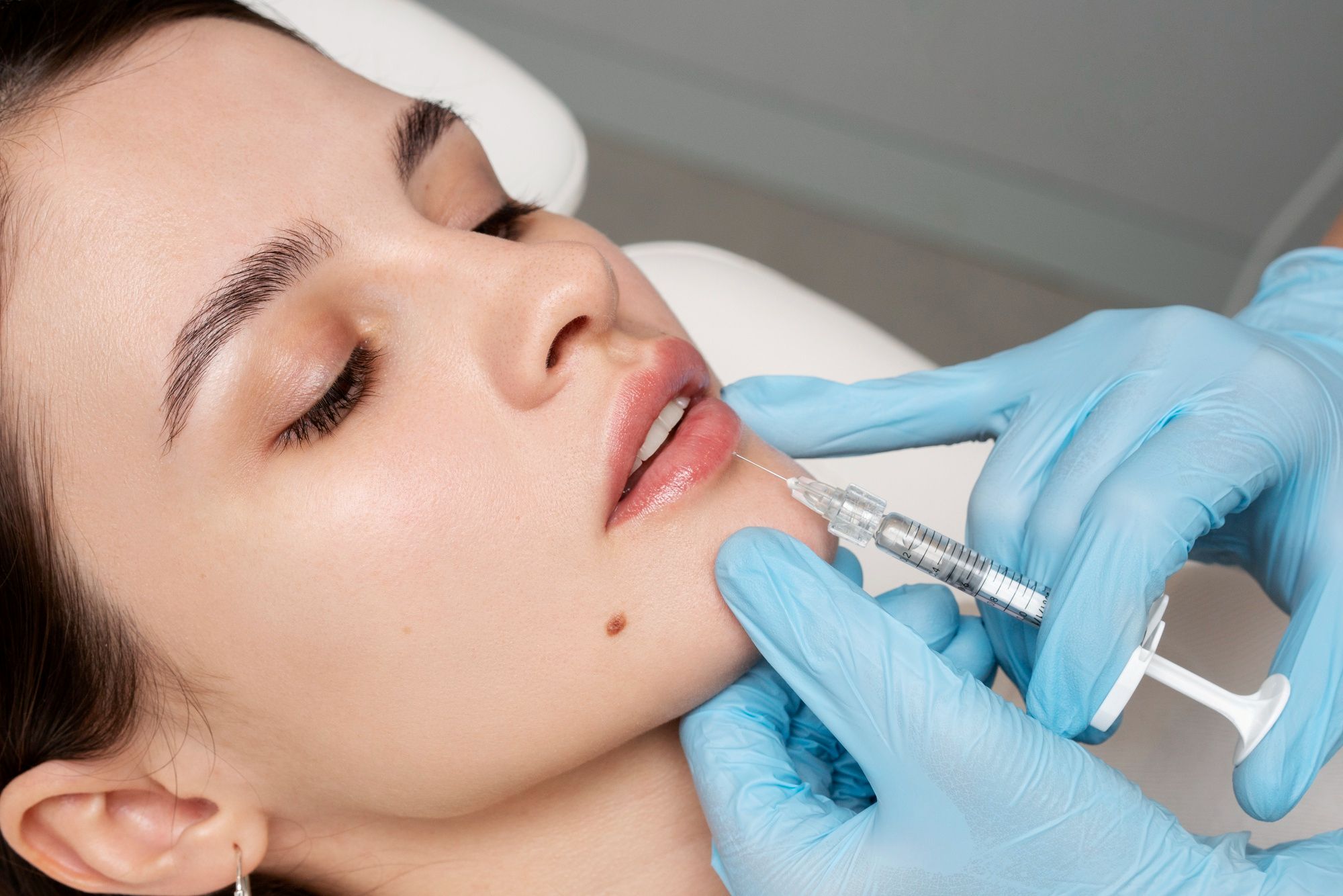 Hylase-Behandlung, Spritzenbehandlung an den Lippen einer Frau