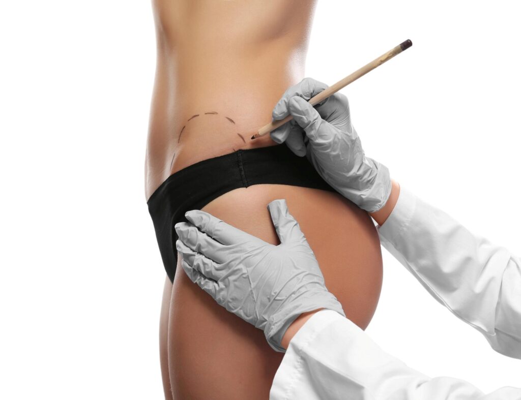 Postbariatrische Chirurgie, Ärztin zeichnet den Eingriff bei der Patientin an