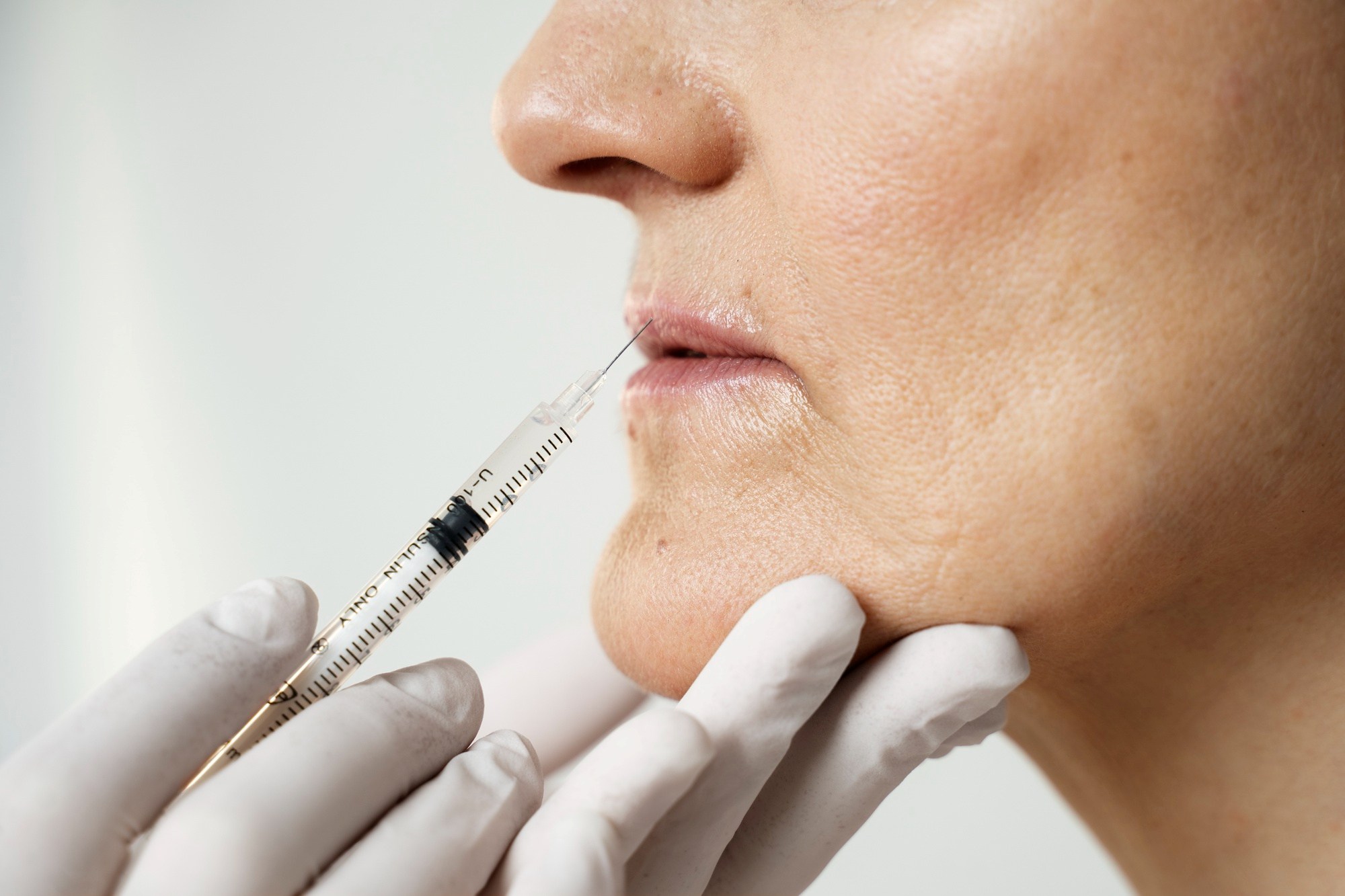 Biostimulatoren, eine Ärztin setzt eine Spritze im Lippenbereich der Patientin
